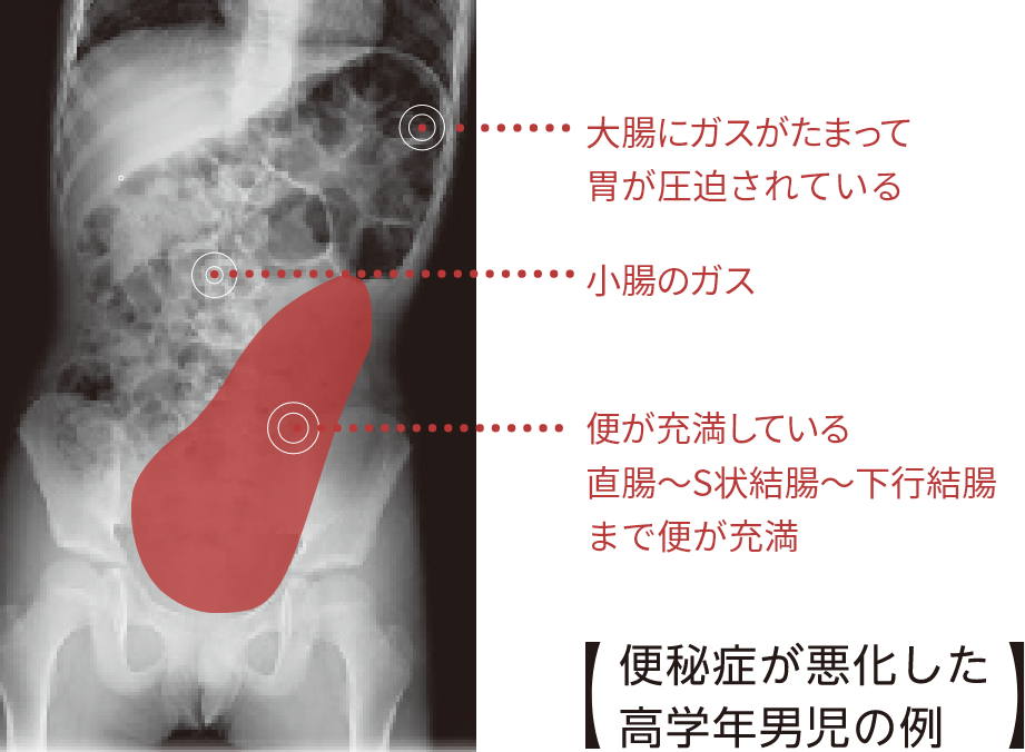 便秘症が悪化した高学年男児の例